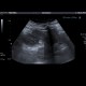 Angiomyolipoma of kidney: US - Ultrasound